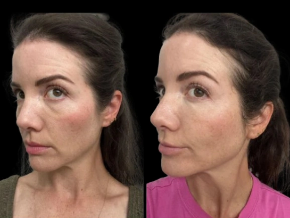 dark circles treatment in dubai