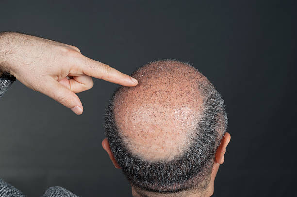 Does FUE Hair Transplant Work For Anyone With Hair Loss