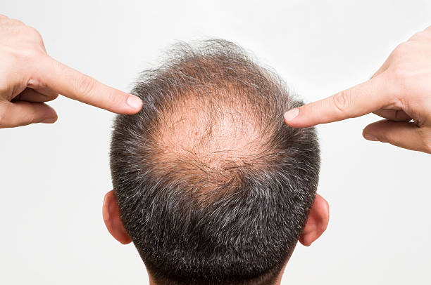 How Quickly Does Hair Loss Treatment Show Hair Results