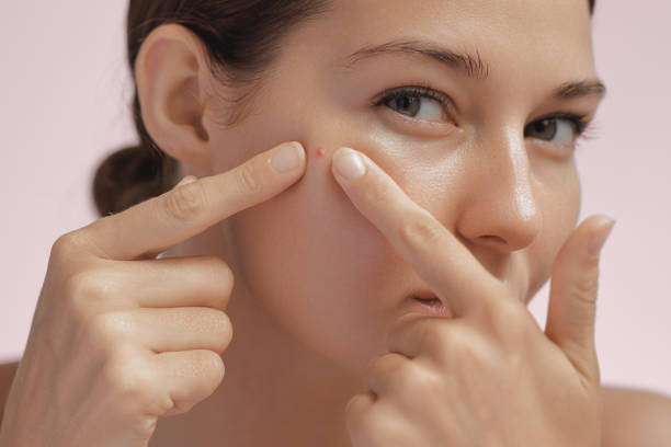 Can Acne Treatment Provide Natural-Looking and Clear Skin Results