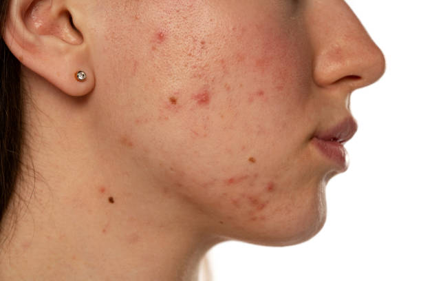 Can Acne Treatment Restore Clearer Skin Tone
