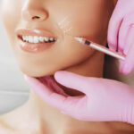 Can Botox Improve Smile Line Appearance