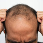 Can GFC Treatment for Hair Treat Receding Hairlines