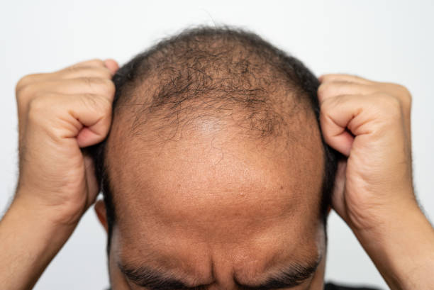 Can GFC Treatment for Hair Treat Receding Hairlines