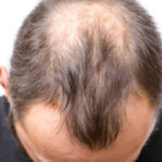 Can Hair Loss Treatment Improve Overall Hair Health