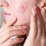 Can Laser Acne Scar Treatment Improve Facial Appearance