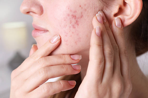Can Laser Acne Scar Treatment Improve Facial Appearance