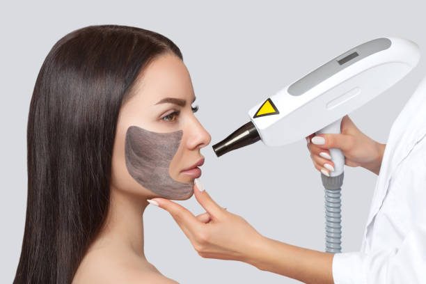 Can Laser Carbon Peel Improve Rough Skin Texture