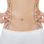 Can Laser Liposuction Treat Love Handles Effectively
