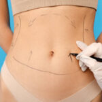 Can Liposuction Improve Confidence in Appearance