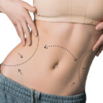 Can Mini Tummy Tuck Help Tighten Ab Muscles