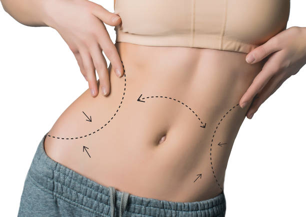 Can Mini Tummy Tuck Help Tighten Ab Muscles