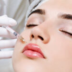Can Russian Lip Fillers Enhance Cupid’s Bow