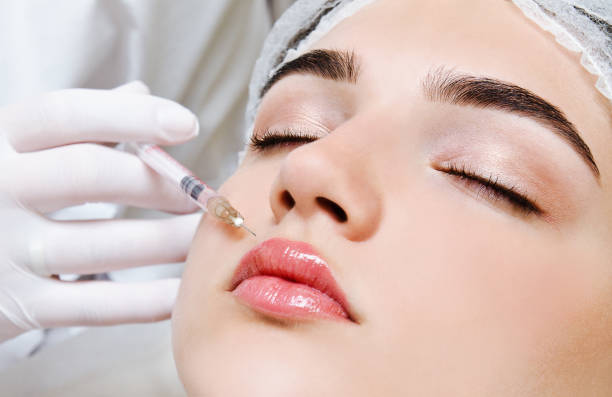 Can Russian Lip Fillers Enhance Cupid’s Bow