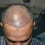 Can SMP Treatment Restore Fuller Looking Hair Fast