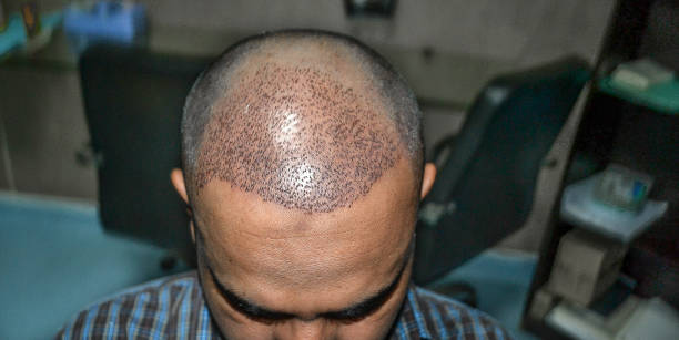 Can SMP Treatment Restore Fuller Looking Hair Fast