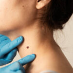 Can Warts Removal Treatment Boost Skin Confidence