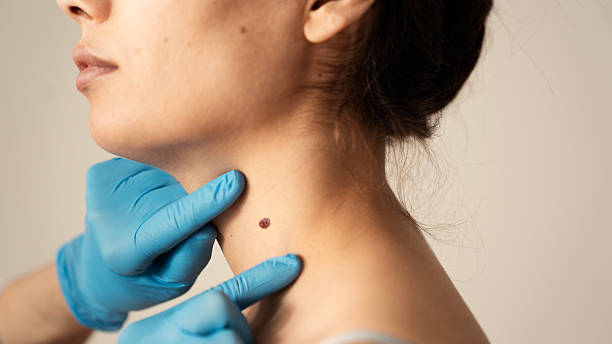 Can Warts Removal Treatment Boost Skin Confidence
