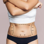 Can a Tummy Tuck Improve Body Proportions Naturally