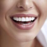 Dental Veneers in Hamilton, ON improving stained, chipped, uneven, and worn teeth with natural-looking cosmetic results