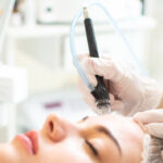 Does HydraFacial Help Remove Blackheads Gently