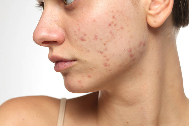 Does Laser Acne Scar Treatment Help Dark Spots