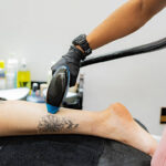 Does Laser Tattoo Removal Damage the Skin