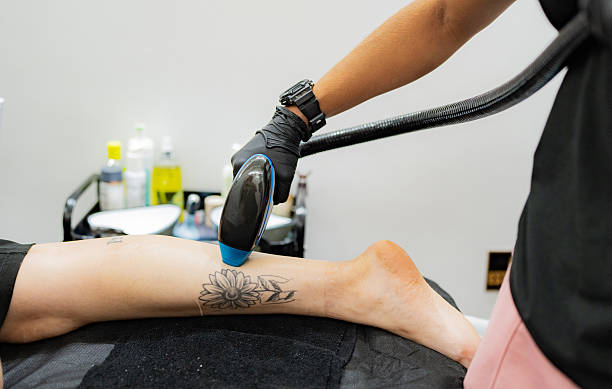 Does Laser Tattoo Removal Damage the Skin