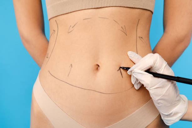 Does Mini Tummy Tuck Improve the Shape of the Belly Button