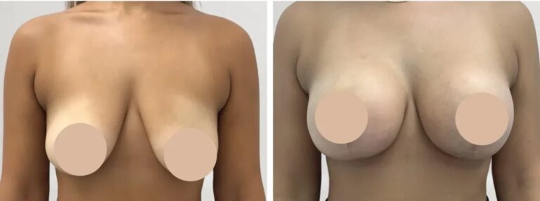 breast reduction