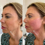 EndoliftTreatment in Dubai for Skin Firming and Lifting Benefits