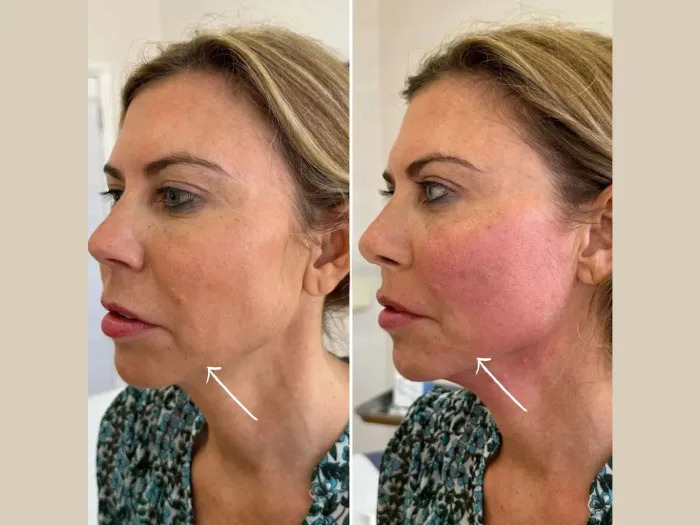EndoliftTreatment in Dubai for Skin Firming and Lifting Benefits