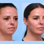 Best Plastic Surgeon in Dubai Delivering Customized Anti Aging Thread Lift Procedures