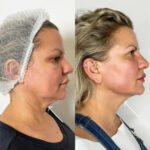 Endolift in Dubai for Natural Skin Tightening Without Surgery