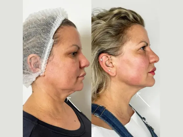 Endolift in Dubai for Natural Skin Tightening Without Surgery