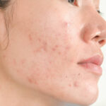 Is Acne Treatment Effective for Stubborn Acne