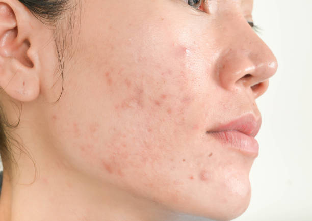 Is Acne Treatment Effective for Stubborn Acne