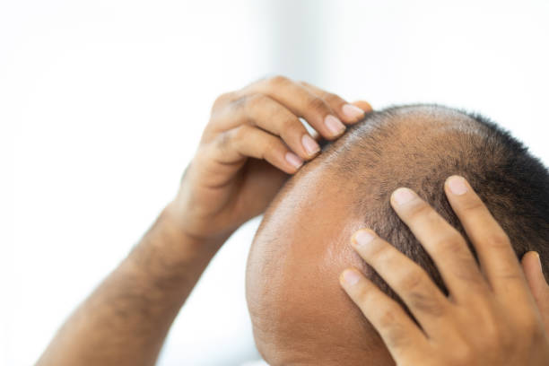 Is GFC Treatment for Hair Suitable for Early Hair Loss