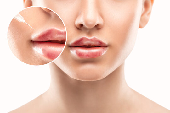 Lip Augmentation in Riyadh