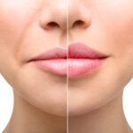 Lip Enlargement in Riyadh