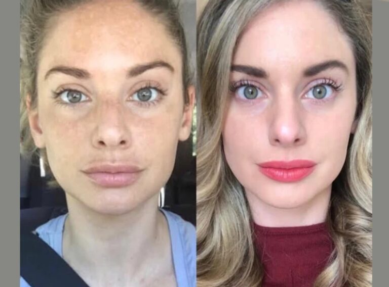 Radiofrequency (RF) Microneedling in Dubai