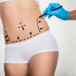 What Are the Main Benefits of Tummy Tuck Today