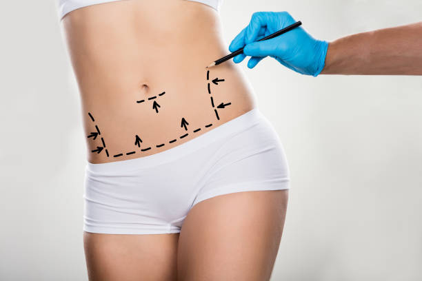 What Are the Main Benefits of Tummy Tuck Today