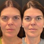 Best Aesthetic Clinic in Dubai Providing Expert Thread Lift Solutions