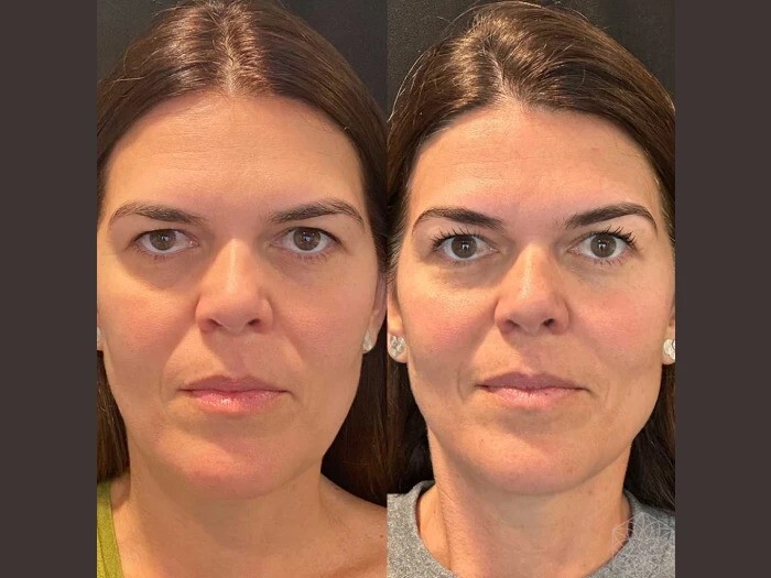 Best Aesthetic Clinic in Dubai Providing Expert Thread Lift Solutions