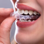 Close-up Of A Woman's Hand Putting Transparent Aligner In Teeth