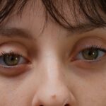 under-eyes-bags-removal-in-dubai