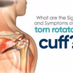 torn rotator cuff