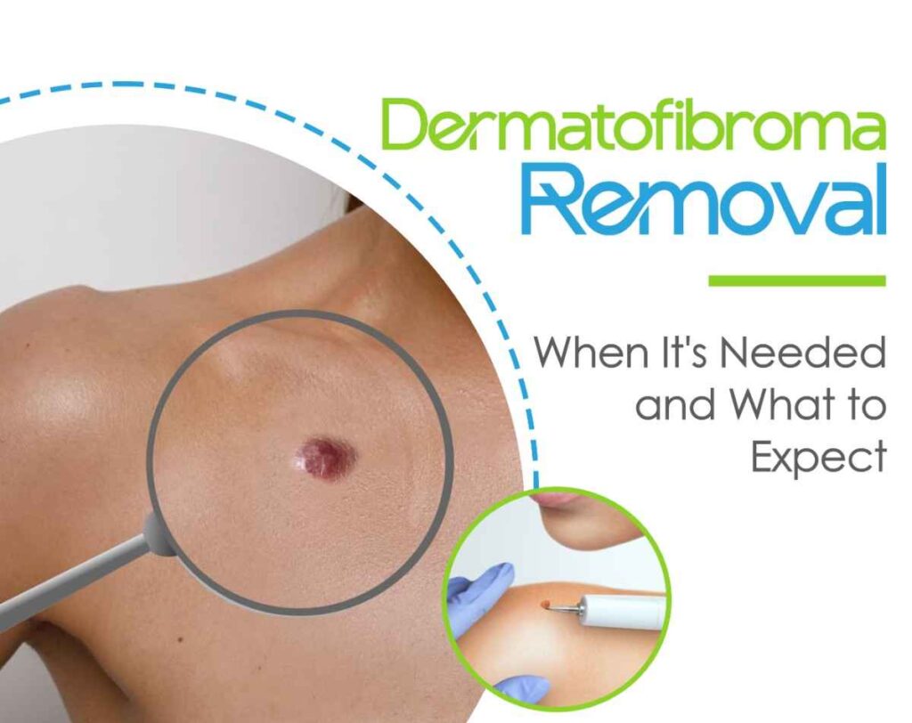 dermatofibroma