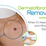 dermatofibroma